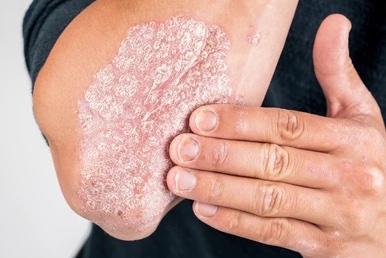 Understanding Psoriasis: A Dermatologist’s Guide